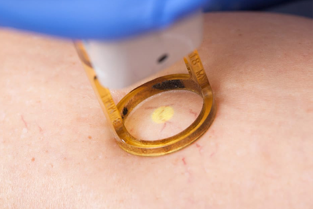 Vein Removal Newdermamed Cosmetic and Laser Clinic